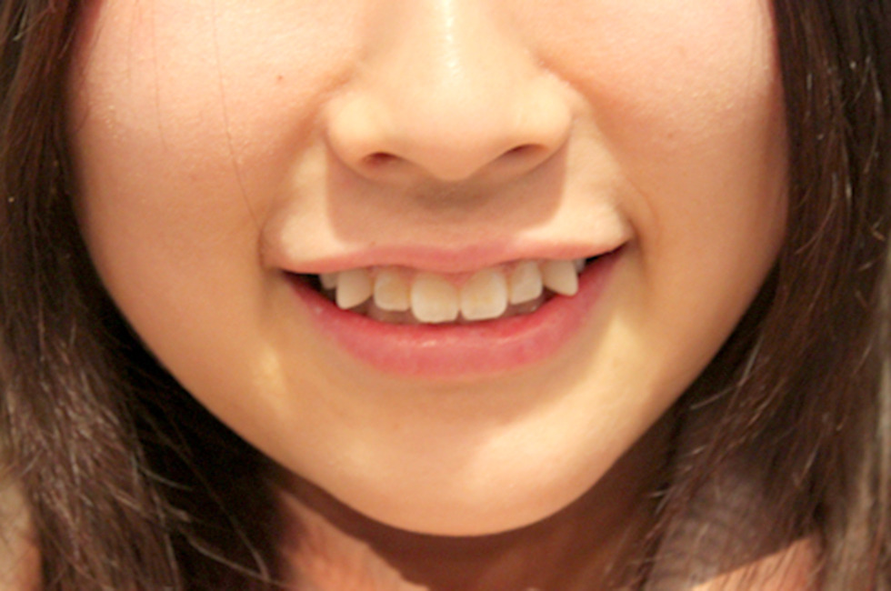 Black Teeth or Snaggle Teeth? Japanese Cosmetic Dentistry - CVLT Nation