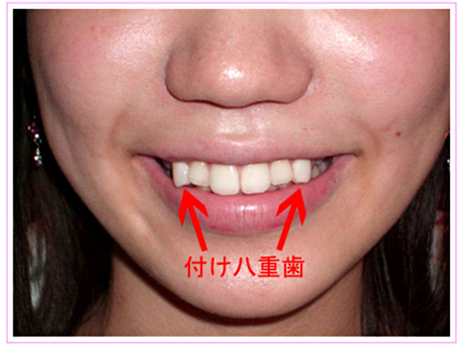Black Teeth Or Snaggle Teeth Japanese Cosmetic Dentistry Cvlt Nation 