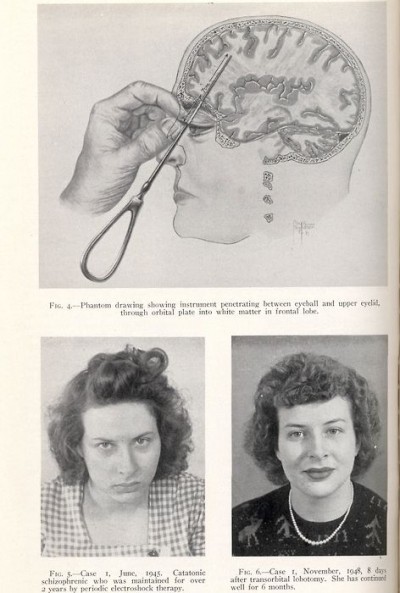lobotomy before and after brain