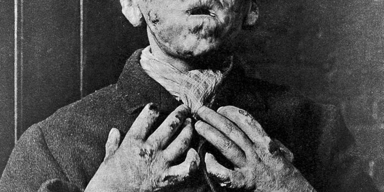 Gross Stuff from the Bible… Images of Leprosy | CVLT Nation